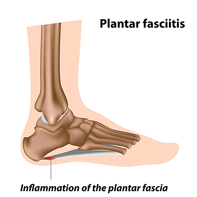 6 Ways to Prevent Chronic Ankle Instability