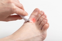 Athlete’s Foot Affects the Skin on the Feet