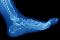 How to Find Relief for Arthritis in the Foot