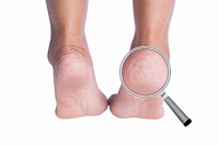 Lack of Vitamins May Lead to Cracked Heels