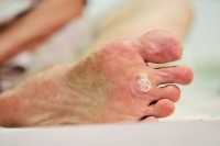 What Causes Plantar Warts to Develop?